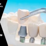 Choosing between Bridges and Crowns for Dental Implants in China